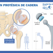 USP Cadera